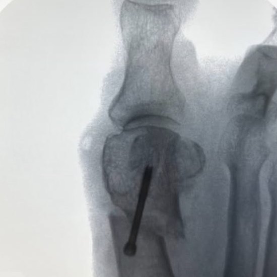 Radioscopia intraoperatoria de un juanete corregido por vía percutánea, con el tornillo que fija la cabeza del primer metatarsiano