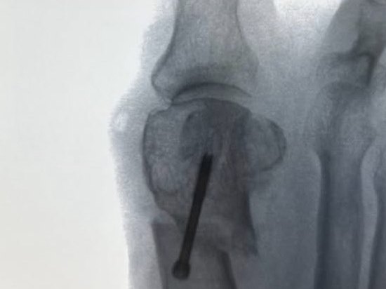 Radioscopia de un juanete corregido por vía percutánea y fijado con un tornillo